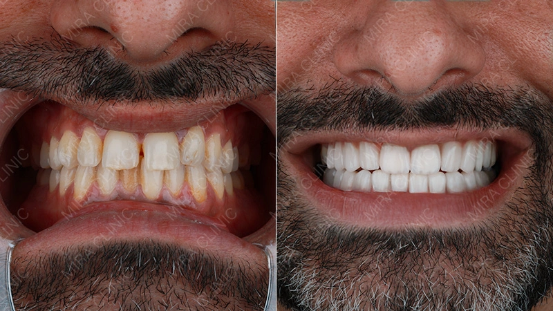 Porcelain-Based Restorations